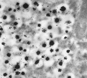 F,68y. | APUD carcinoma (Bodian siver impregnation) F,68y. | APUD carcinoma (Bodian siver impregnation)
